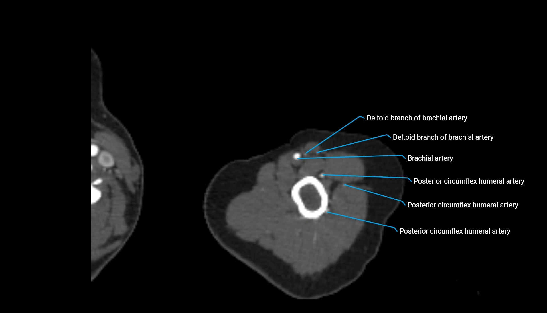 CTA upper limb axial cross sectional anatomy labelled image 305 (2).webp